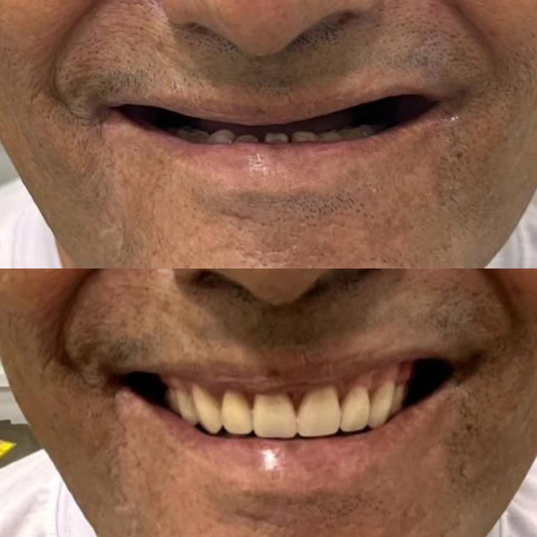 Antes e depois — Paciente 1 — Lentes em Resina CDT