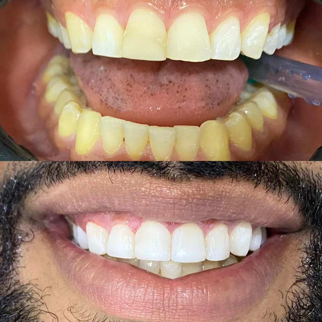 Antes e depois — Paciente 2 — Lentes em Resina CDT