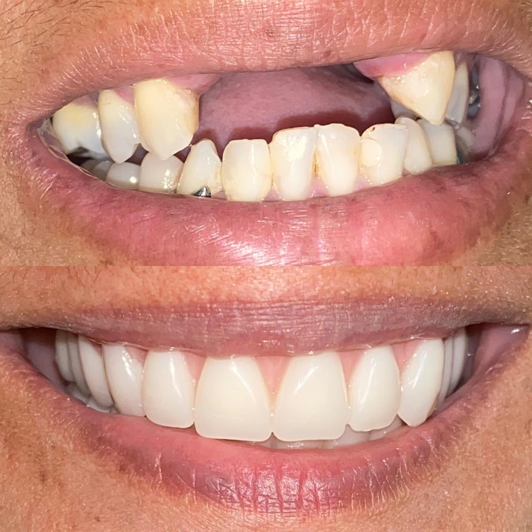Antes e depois — Paciente 3 — Lentes em Resina CDT